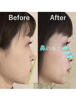 ラプリ 大宮店(Raplit)/隆鼻＋輪郭矯正40分10回