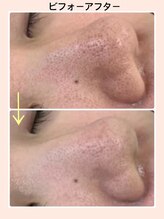 リファイン(REFINE)/毛穴洗浄！黒ずみ解消！