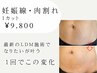 妊娠線・肉割れにアプローチ！LDMエステ★1カット9800円