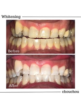 シュシュ(chouchou)/高濃度医療提携機関ジェル比較