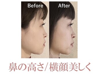 ラプリシュシュ 岡山店(Raplit)/ 隆鼻+輪郭矯正40分10回