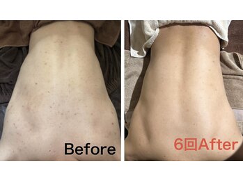 エミルカ 北谷店(EMILUCA)/背中のニキビ