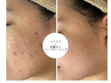 ベル(Belle)の雰囲気（ハイドラ＋ハーブは直後から効果がわかりやすくおすすめです♪）
