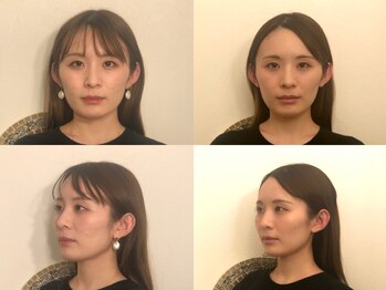 フラット(FURATTO)/Before - After【施術約10回】