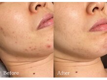 綺麗サロン 脱毛アンドフェイシャル ジュエル(Jewel)/【4BミネラルクリアTR】