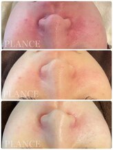 プランス 恵比寿店(PLANCE)/赤み/エステ/肌荒れ/恵比寿