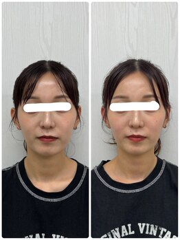 ラフテル鍼灸整骨院/美容鍼でほうれい線がスッキリ♪