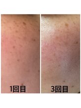 ヘアデザインアンドエステティック リコ(hair design&esthetic rico)/シミケアプラズマ