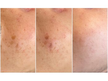 ジン フォー ユアビューティー(JIN for your beauty)/施術経過