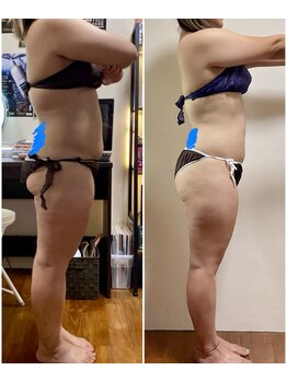 ニコワ(Nicowa)/Nicowaの痩身★BeforeAfter