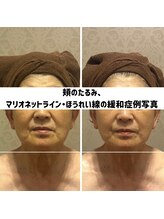 リジェ(Rege)/60代女性の方　施術