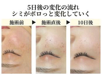 パールホワイトニング/シミケア後5日でポロッと取れる