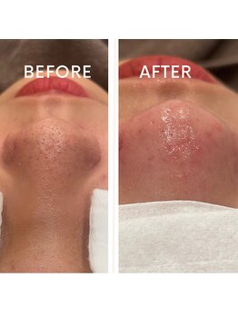 ルナート(Lunart)/毛穴洗浄/毛穴ケア