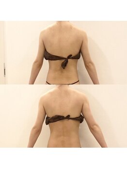 デンオブ(Den of)/【痩身ダイエット】WINBACK背中