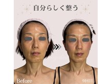 アンジェリカ(Angelica)の雰囲気（エステや小顔矯正、糸でも変わらなかった方にも支持されています）
