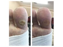 厚木 海老名 巻き爪矯正センター/事例【ドイツ式フットケア】