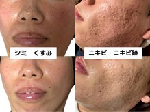 アキュセル ヨウコナース アンド 暢子美容鍼灸(Accu:Cell Youko nurse)の雰囲気（他のエステサロンでは体験できない美容鍼×フェイシャルメニュー）