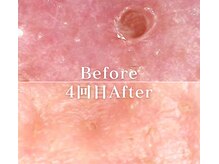 ミニョスキンラボ/韓国式ハーブピーリング4回