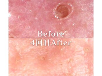 ミニョスキンラボ/韓国式ハーブピーリング4回