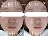 【8月限定】ツヤ肌　医師監修の乳酸ピーリング×イオン導入