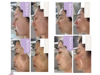 エミット(emit.)/瞬間引き上げ