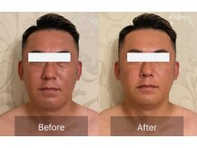 メディボーテサロン(MEDI BEAUTE SALON)/ほうれい線がきれいになる