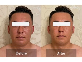 メディボーテサロン(MEDI BEAUTE SALON)/ほうれい線がきれいになる