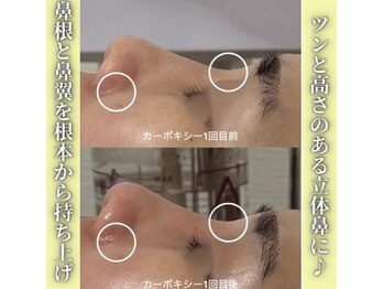 ハニエル(Haniel)/カーボキシー症例