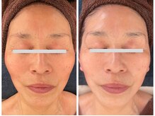 ファシル(Facile)/小顔造形Vラインリフト
