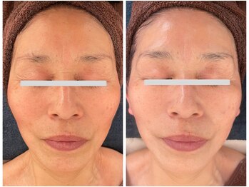 ファシル(Facile)/小顔造形Vラインリフト