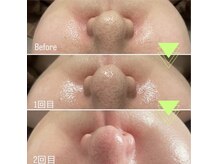 ユイ(YUI)/鼻の黒ずみ毛穴ケア・透明感