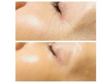 ティーエムスタジオ(TM sutajio)の雰囲気(世界最先端マシンJETPEELで目元に天然BTX)