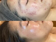 ビジュープラス 広島店(Bijou+)/【20代/ニキビケア】