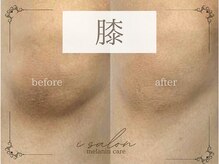 アイサロン(i.salon)/メラニンケア