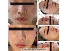 乳酸ピーリング＆ホームケア☆黒ずみ改善、リフトＵＰ効果大！