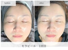 ビー(Be.)/セラピール1回