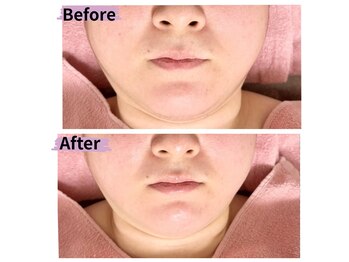 マリア(MALIA)/顎下スッキリ比較