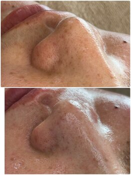 リノ(Lino)/鼻の黒ずみもしかして毛かも！