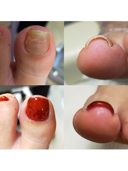 ナビネイル(Nabi nail)/巻き爪ケア+ジェル