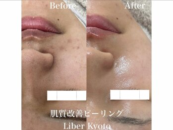 エステティック リベル キョウト 京都駅前店(Esthetic Liber Kyoto)/肌質改善ピーリング
