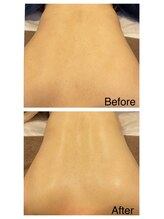 ルアナ 倉敷店(LUANA)/背中ニキビケア改善例