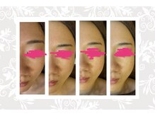 ヴィヴ コレビ(VIV COREBI)/最短1ヶ月で別人美肌