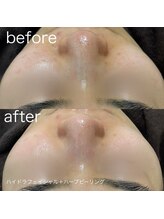 ルルラ リコ(lulula rico)/症例写真/ハイドラ毛穴洗浄