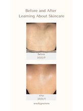 パール エビス(Pearl Ebisu)/背中ハーブピーリング