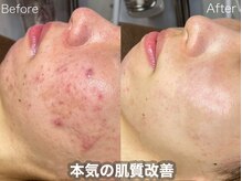 ラティーナ(Lattina)/ニキビケア