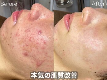 ラティーナ(Lattina)/ニキビケア