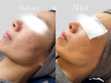 アイシス(AIsis)/ニキビ凹凸【5ヶ月】