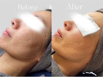 アイシス(AIsis)/ニキビ凹凸【5ヶ月】