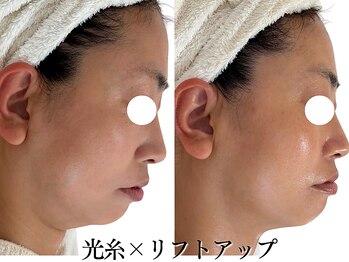 ボディメイキング キキ(Bodymaking KIKI)の写真/【切らない！打たない！最新リフトアップ】韓国でも人気の光糸×リフトアップでたるみをグっと引き上げる◎