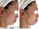 ボディメイキング キキ(Bodymaking KIKI)の写真/【切らない！打たない！最新リフトアップ】韓国でも人気の光糸×リフトアップでたるみをグっと引き上げる◎